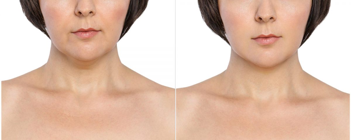Photo: before and after pictures of chin scuplting